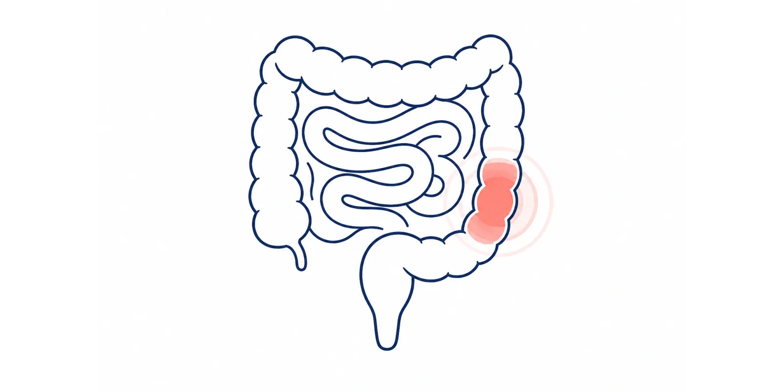 Ilustração de um intestino com um sinal de inflamação em destaque